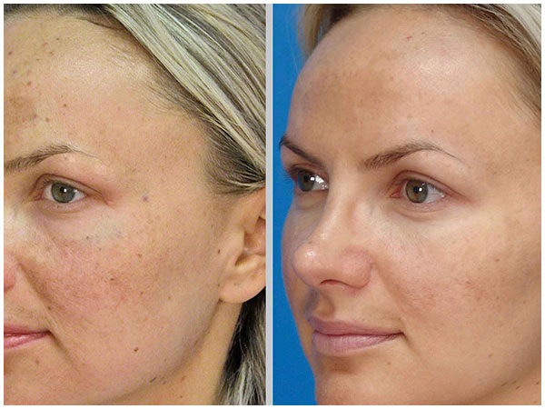 MicroLaserPeel Laser Treatment Before and After