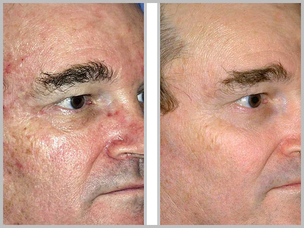 Microlaser Peel Before and After